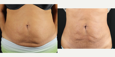 BodyTite before and after photo