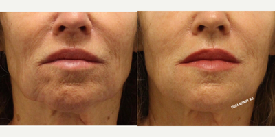 Fraxel Laser before and after photo
