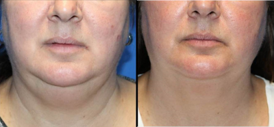 Kybella before and after photo