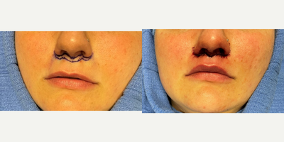 Lip Lift before and after photo