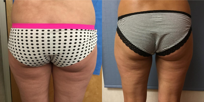 Liposuction before and after photo