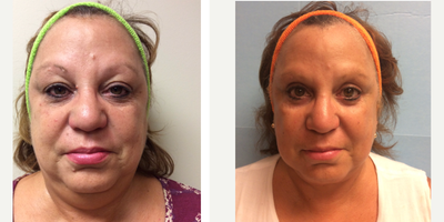 Mole Removal before and after photo