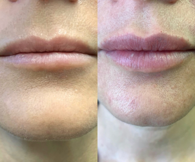 Restylane before and after photo