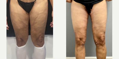 Thigh Lift before and after photo