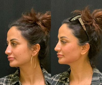 Thread Lift before and after photo
