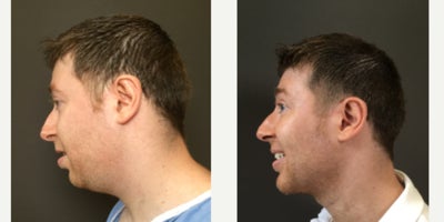 Chin Implant before and after photo