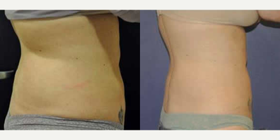 CoolSculpting before and after photo