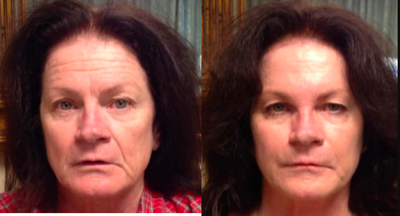 Dermal Fillers before and after photo