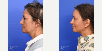 Facial Fat Transfer before and after photo