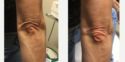 Pelleve before and after photo