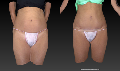 Tummy Tuck before and after photo