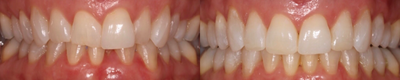 Clear Braces before and after photo