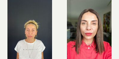 Eyelid Surgery before and after photo