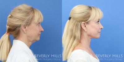 Eyelid Surgery before and after photo