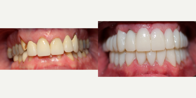 Porcelain Veneers before and after photo