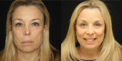 Eyelid Surgery before and after photo
