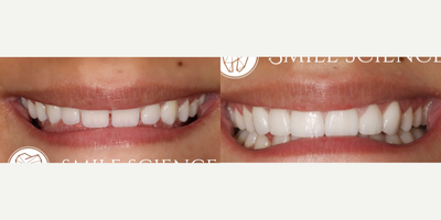 Porcelain Veneers before and after photo