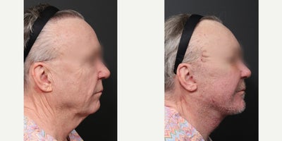 Eyelid Surgery before and after photo