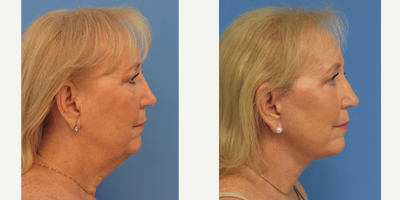 Facelift before and after photo