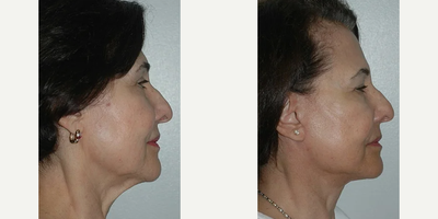 Lower Facelift before and after photo