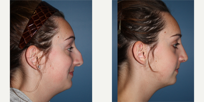 Rhinoplasty before and after photo