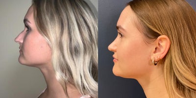 Septoplasty before and after photo