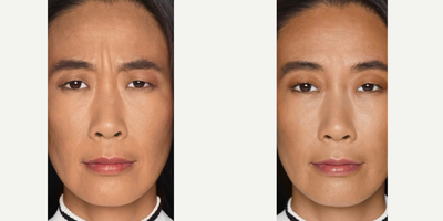 Botox before and after photo