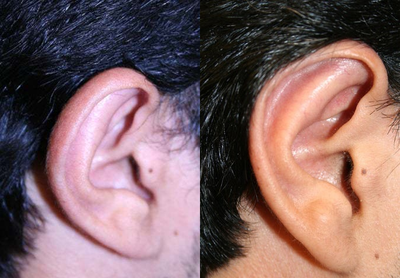 Ear Surgery before and after photo