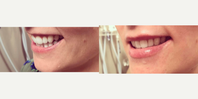 Juvederm before and after photo