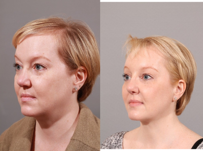 Revision Rhinoplasty before and after photo