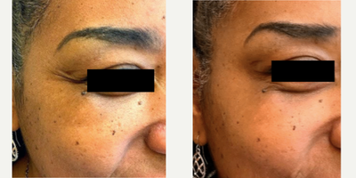 Botox before and after photo