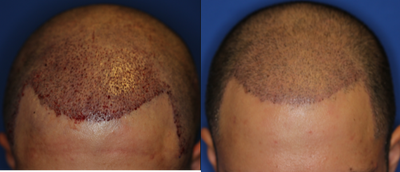 FUE Hair Transplant before and after photo