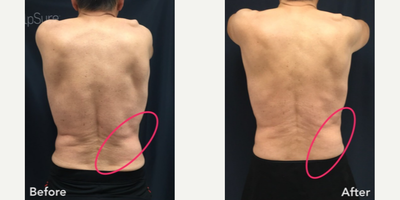 SculpSure before and after photo