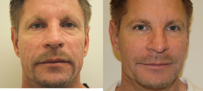 Sculptra before and after photo