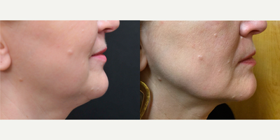 ThermiTight before and after photo