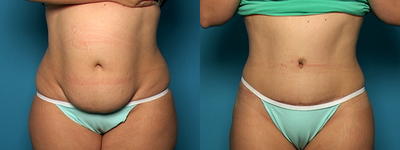 Tummy Tuck before and after photo