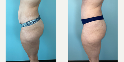 Tummy Tuck before and after photo