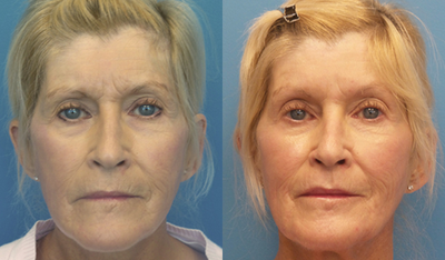 Botox before and after photo