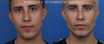 Botox before and after photo