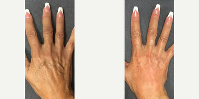 Hand Rejuvenation before and after photo