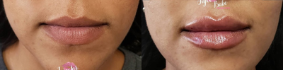 Juvederm before and after photo
