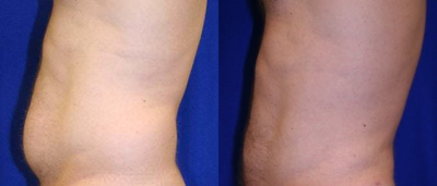 Liposuction before and after photo