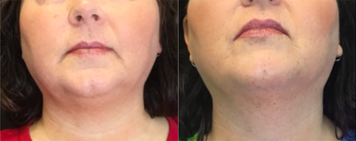 CoolSculpting before and after photo