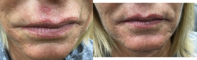 Dermal Fillers before and after photo