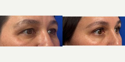 Eyelid Surgery before and after photo