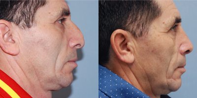 Rhinoplasty before and after photo