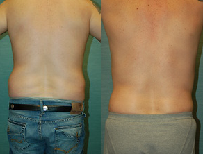 Liposuction before and after photo