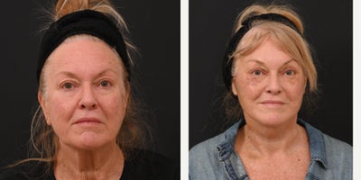 Deep Plane Facelift before and after photo