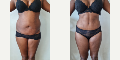 Liposuction before and after photo
