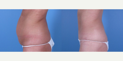Tummy Tuck before and after photo